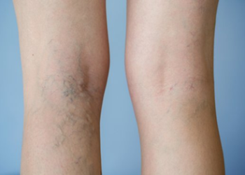 Gambe leggere e in salute: al Poliambulatorio ALG arriva la scleroterapia