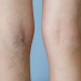 Gambe leggere e in salute: al Poliambulatorio ALG arriva la scleroterapia